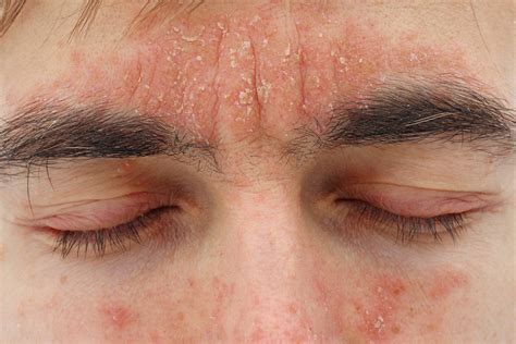Seborrhoeic Dermatitis .
